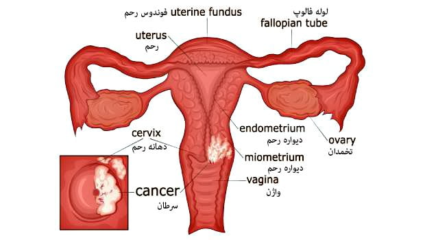cancer1 سرطان دهانه رحم