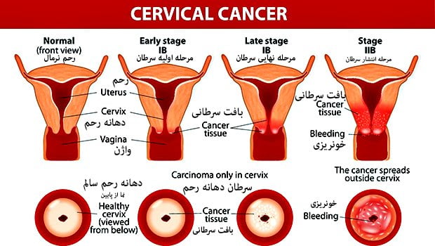 cervical-cancer درمان سرطان دهانه رحم