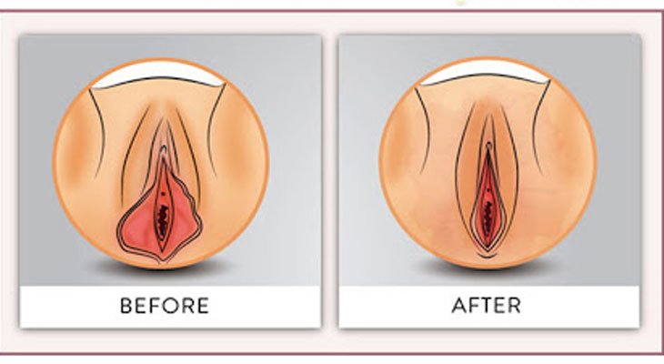 لابیپلاستی با لیزر