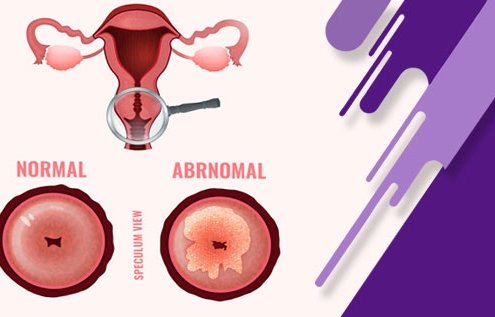 سرطان دهانه رحم