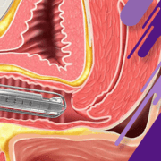 آشنایی با انواع روشهای جوانسازی دستگاه تناسلی خانمها