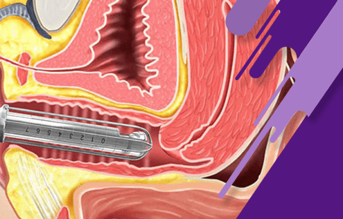 آشنایی با انواع روشهای جوانسازی دستگاه تناسلی خانمها