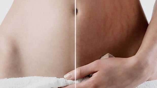 pregnancy10 ترک پوستی چیست؟