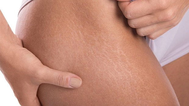 pregnancy11 روشهای ردمان ترک پوستی