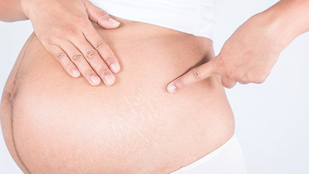 pregnancy13 قرمزی ترک پوستی