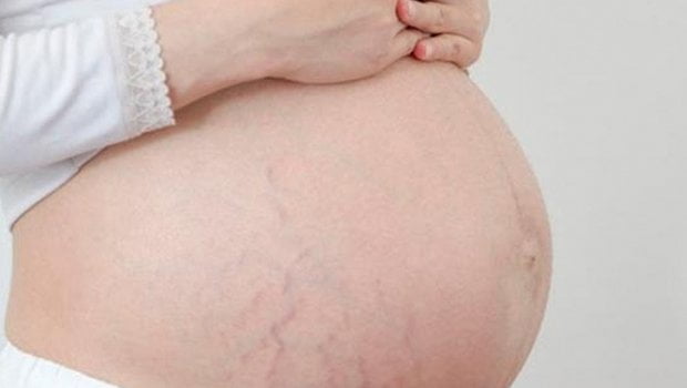 pregnancy15 علائم ترک پوستی