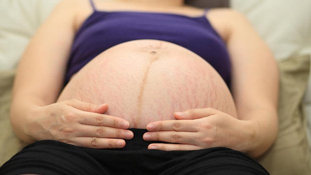 pregnancy16 درمان ترکهای پوستی