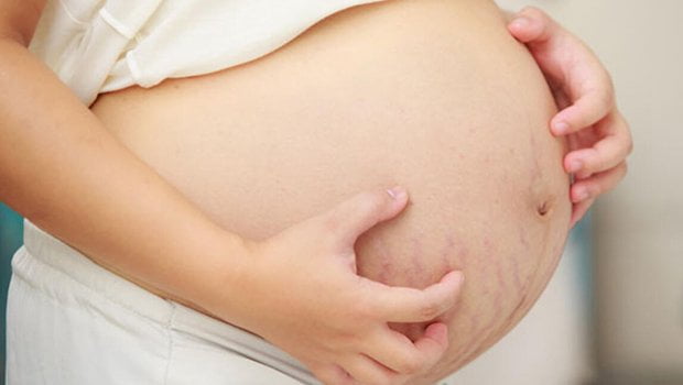 pregnancy3 در مان ترک پوستی