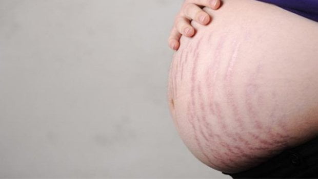 pregnancy6 قرمزی ترک پوستی