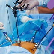 لاپاراسکوپی