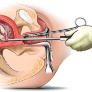 کورتاژ تشخیصی