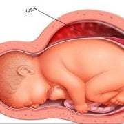 هماتوم در بارداری