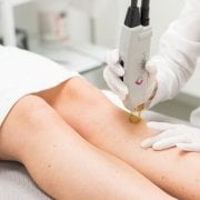 لیزر موهای زائد