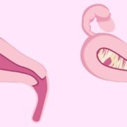 چسبندگی رحم