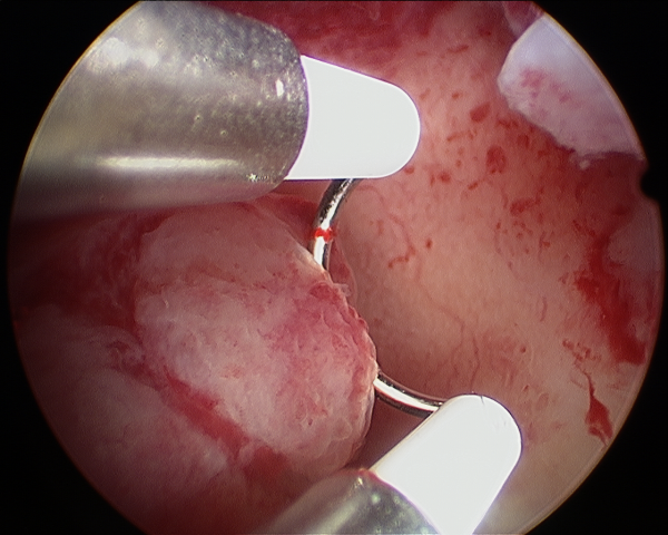 هیستروسکوپی