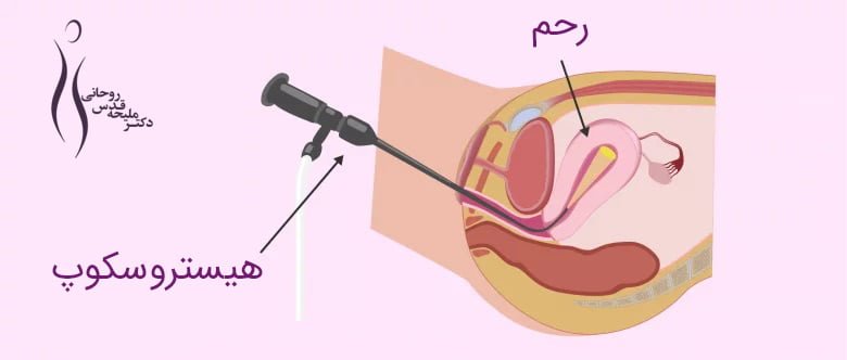 چسبندگی رحم