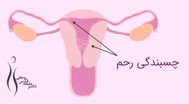 چسبندگی رحم