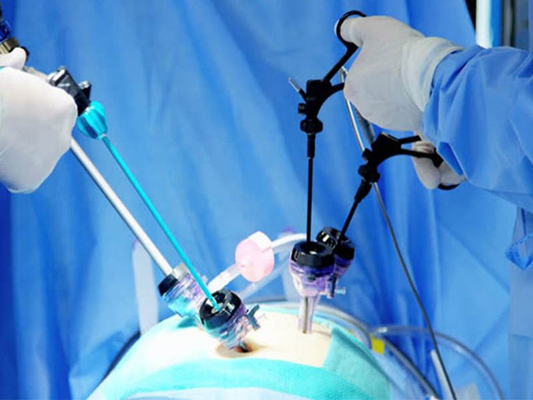 لاپاراسکوپی