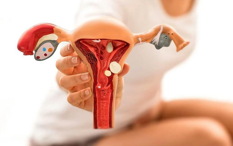 اندومتریوز