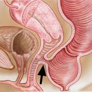 فیستول رکتوواژینال