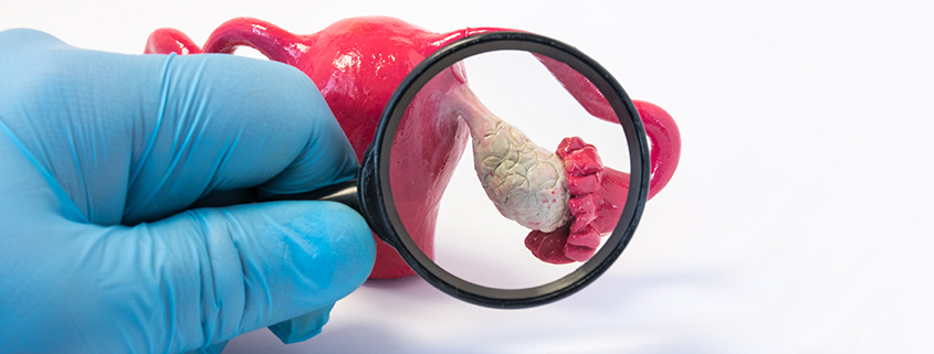 سرطان تخمدان