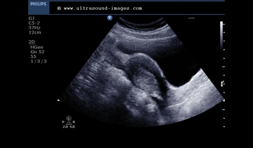 حاملگی خارج رحمی 