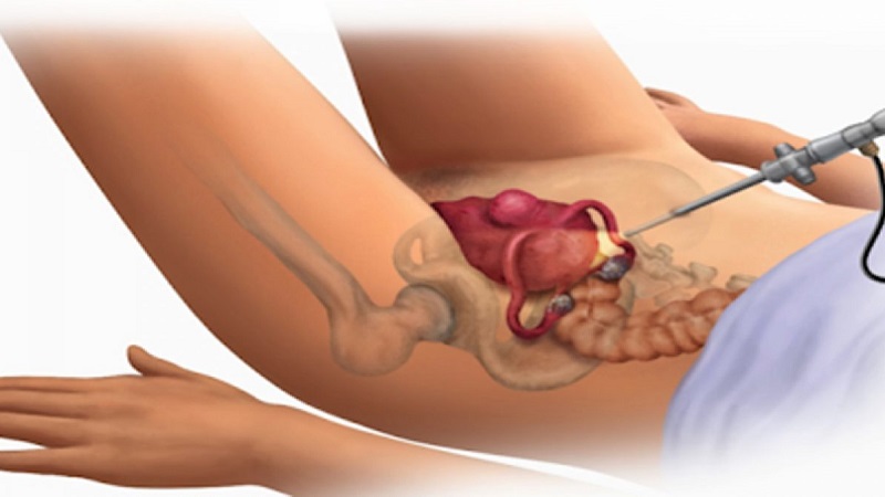 جراحی میومکتومی