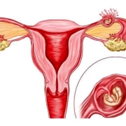 حاملگی خارج رحمی بارداری خارج رحمی