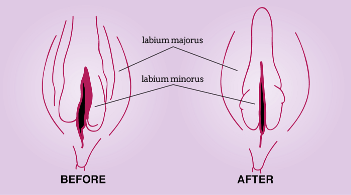 پی ار پی واژن در کرج