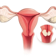 ضایعات دهانه رحم