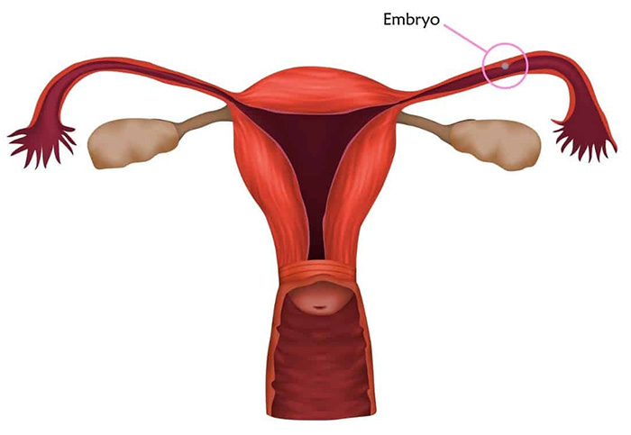 حاملگی خارج رحمی