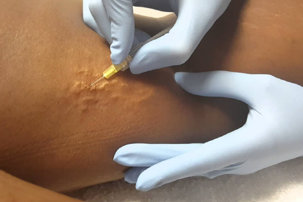 کربوکسی تراپی واژن در کرج دکتر ملیحه روحانی