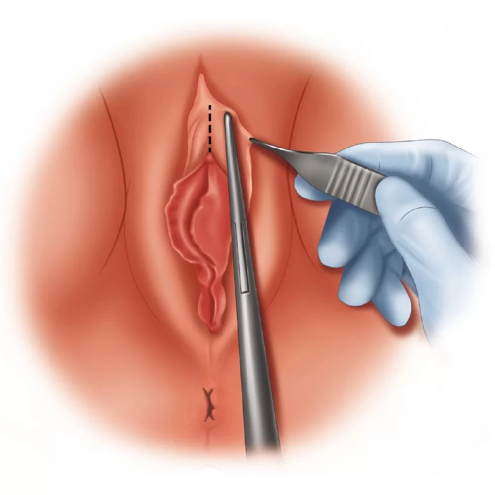 هودکتومی در کرج