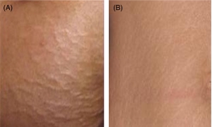 کربوکسی تراپی واژن در کرج دکتر ملیحه روحانی