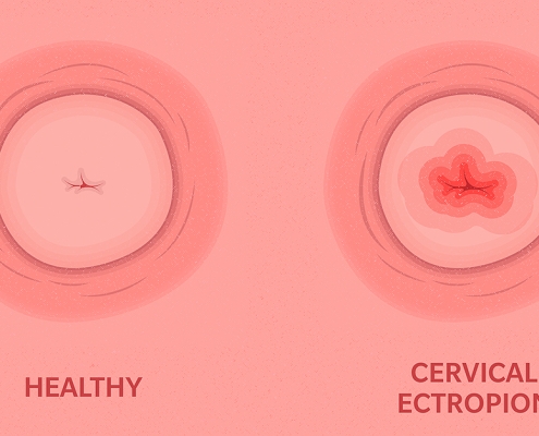 اکتروپیون دهانه رحم