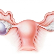 کیست‌ درموئید