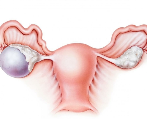 کیست‌ درموئید