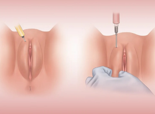 تزریق ژل به واژن