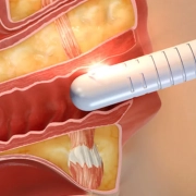 آر اف واژینال در کرج