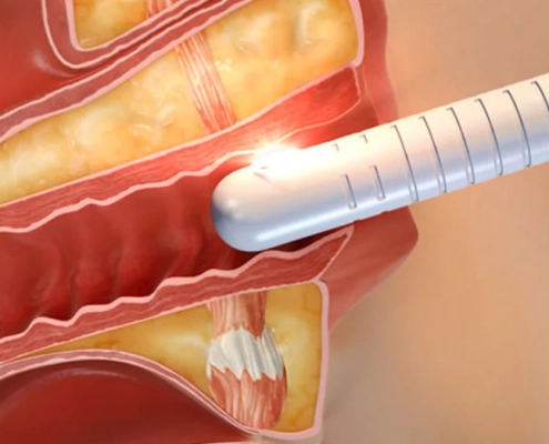 آر اف واژینال در کرج