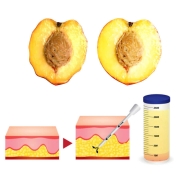 تزریق چربی به واژن در کرج