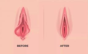 انجام همزمان لابیاپلاستی با لیزر و هودکتومی در کرج