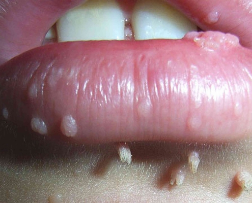 درمان HPV در کرج