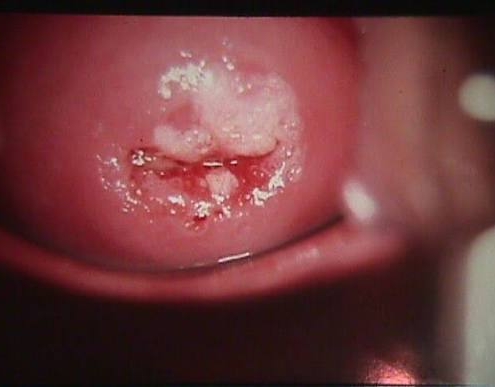 درمان HPV در کرج